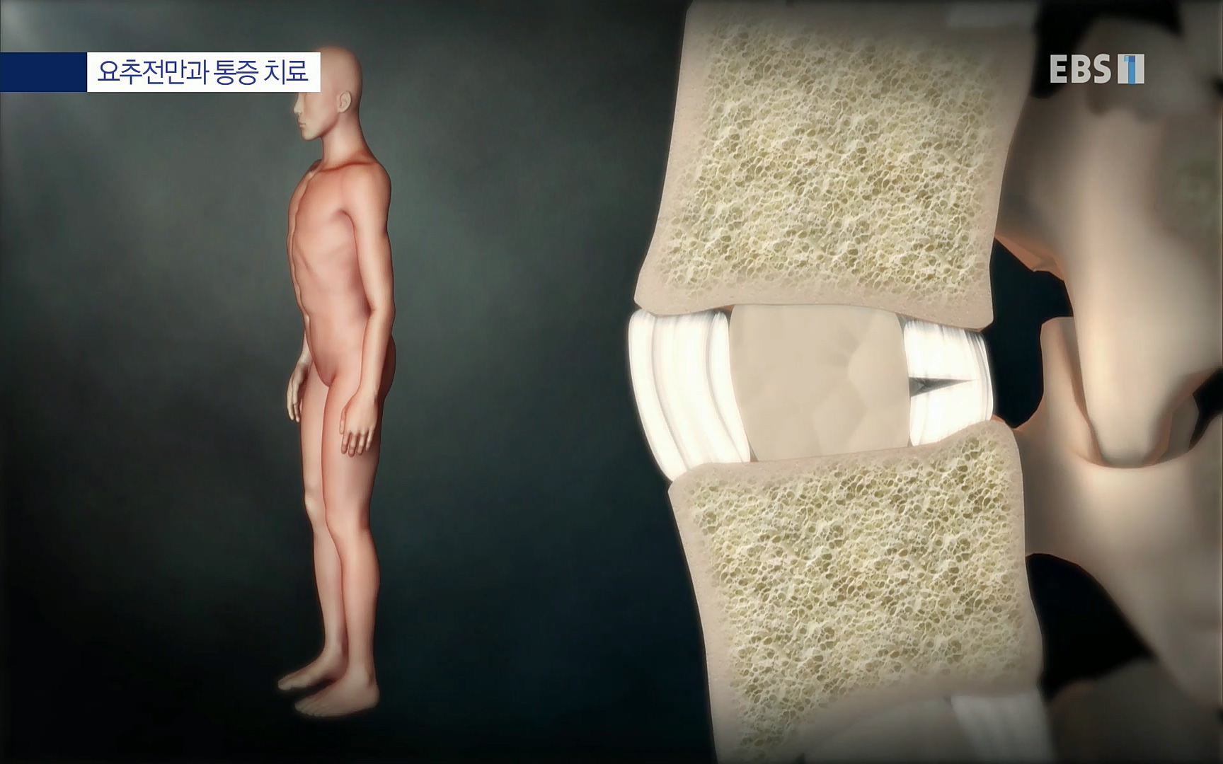 EBS 명의 헬스케어 - TV - 교육의 중심 EBS허리 통증 치료 프로젝트 1부, 수술없이 낫는다 .mp4_20220712_204011.499.jpg
