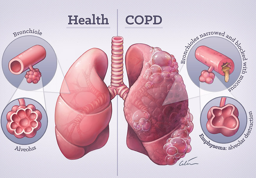 Health and COPD