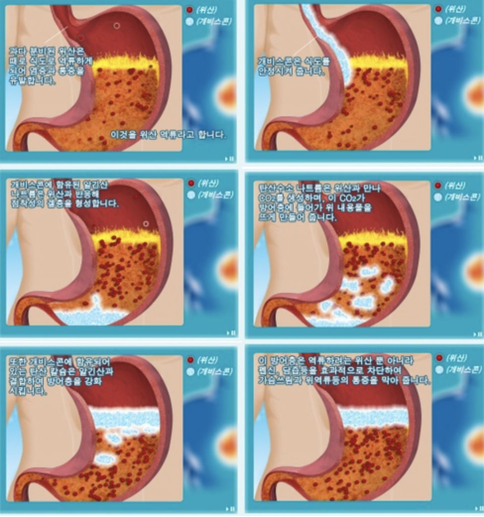  역류성 식도염 치료 언제까지 해야하나?