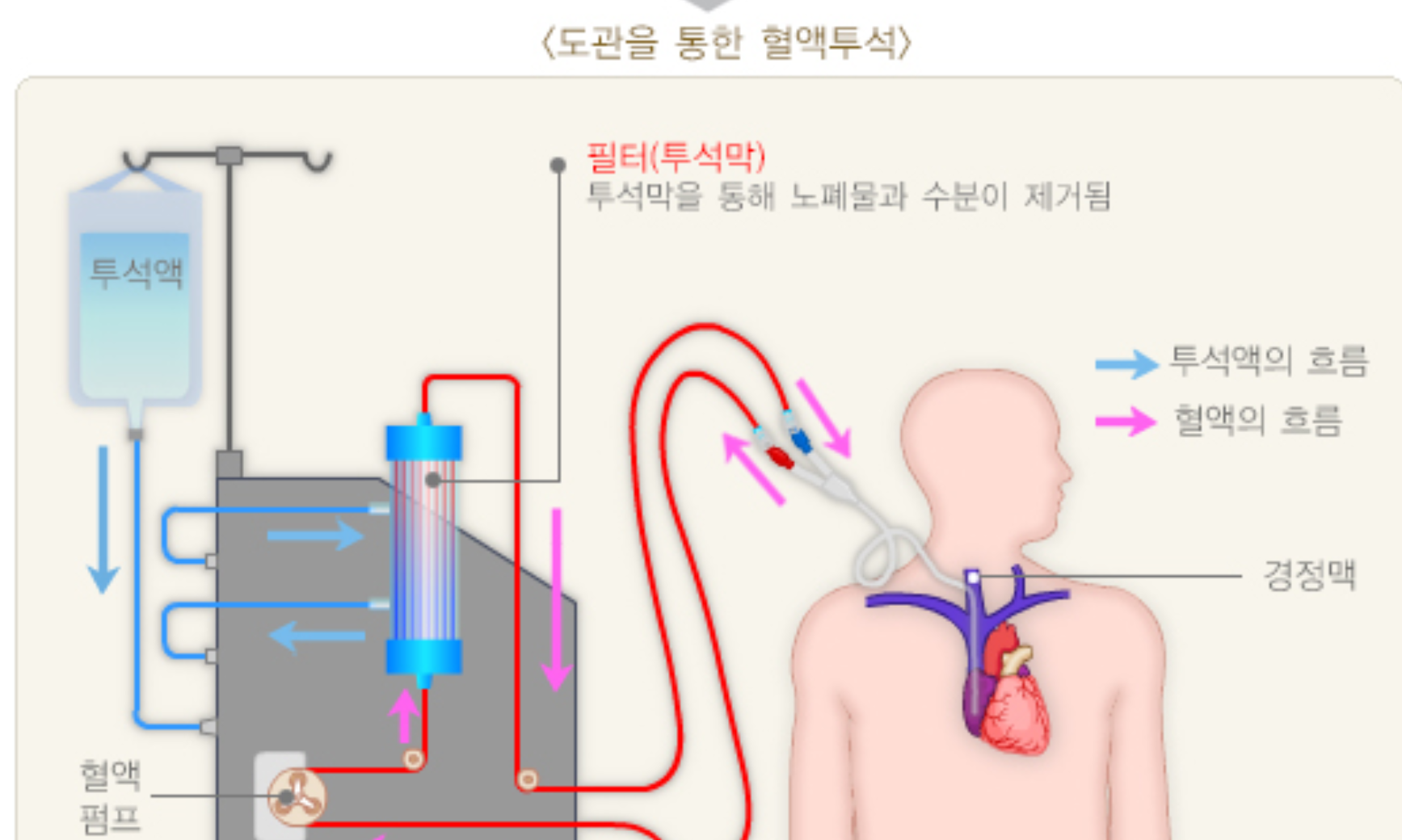 투석