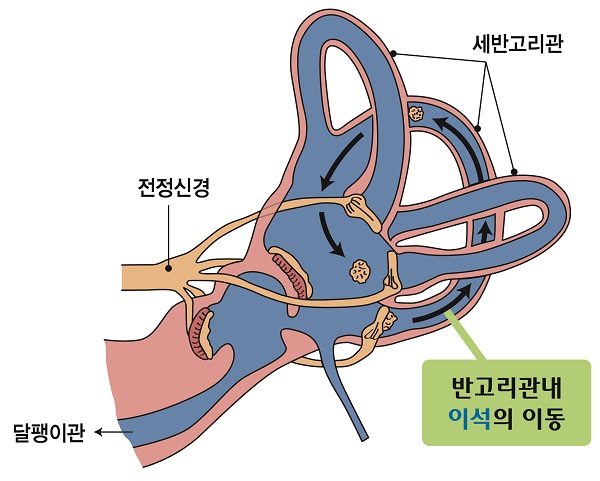 이석증 사진