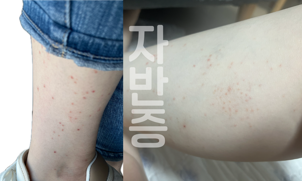 자반증