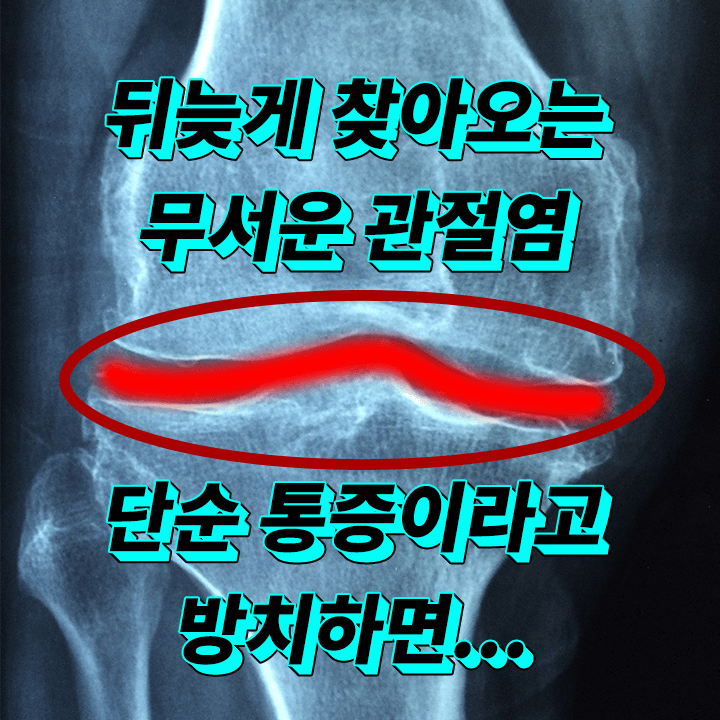 퇴행성-관절염-무릎-손가락-원인-콘드로이친-소-상어-연골-성분-효능