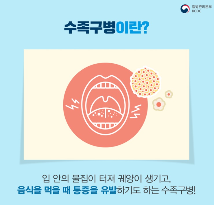 수족구증상-원인-치료방법