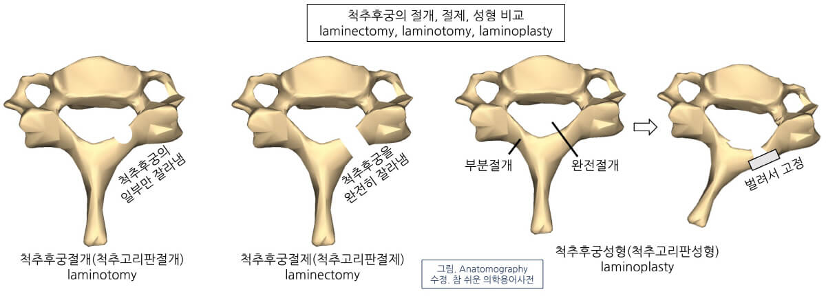 laminotomy, laminectomy, laminoplasty 뜻 척추후궁절개, 척추후궁절제, 척추후궁성형술 수술방법 차이