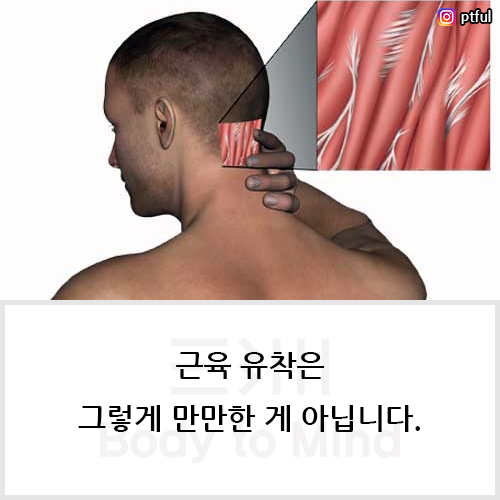  근육 유착(muscle adhesion)은 그렇게 만만한 게 아닙니다.