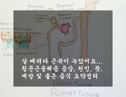  살 빼려다 근육이 녹았어요...횡문근융해증 증상, 원인, 뜻, 예방 및 좋은 음식 요약정리