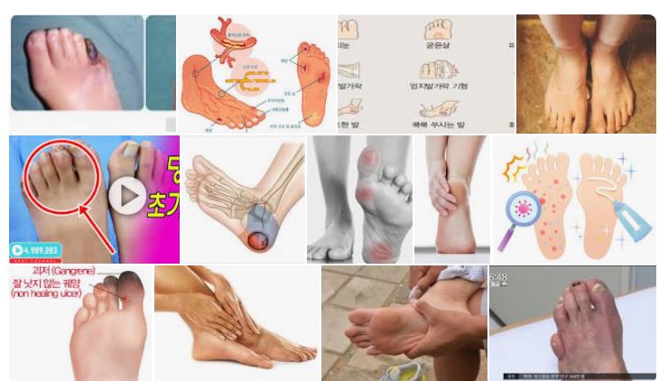 당뇨병 발병상, 다리 저림 치료를 알아둘 것