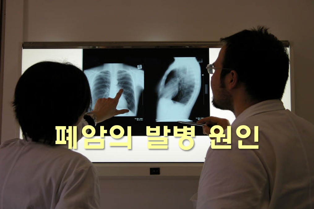  폐암 생존율과 사망률