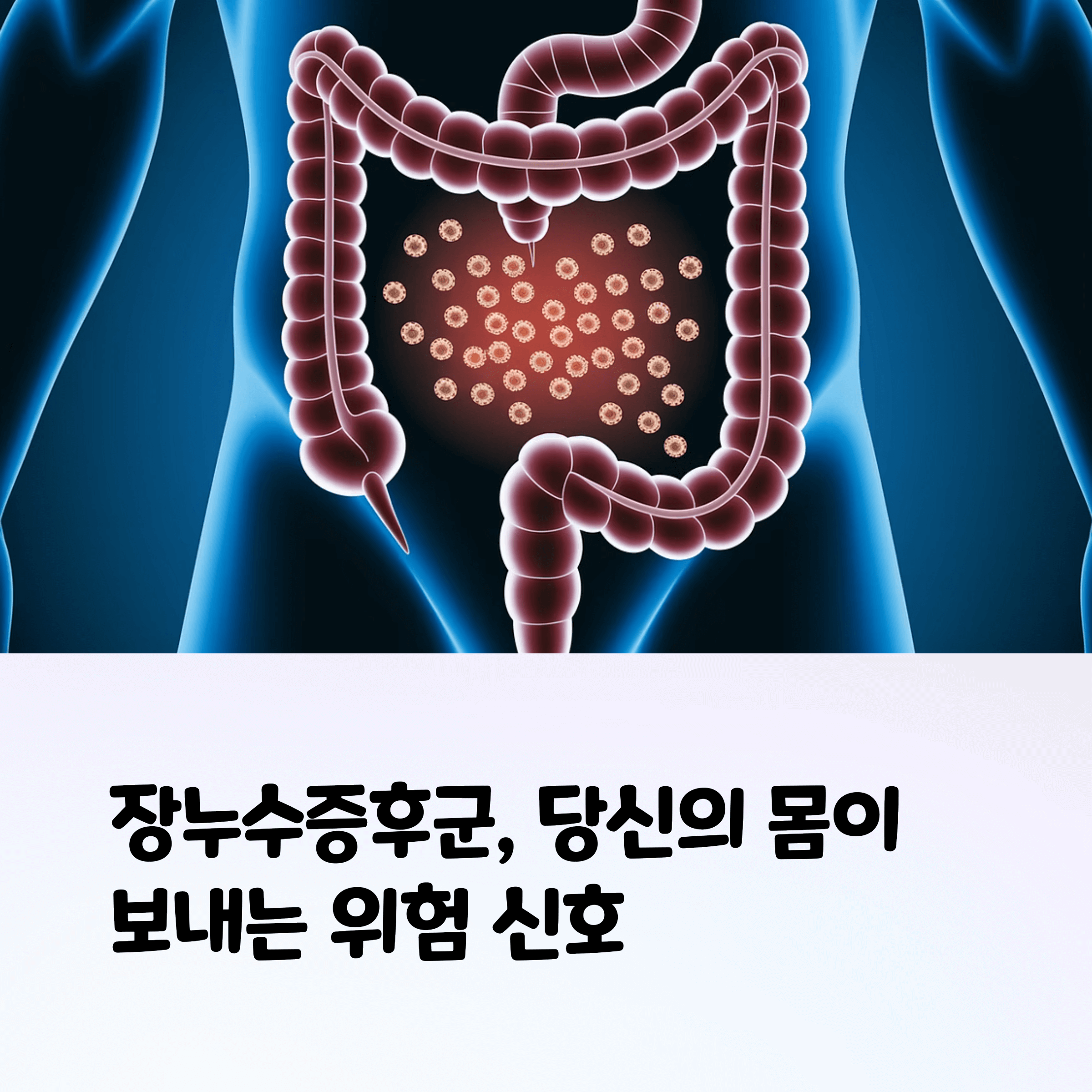 장누수 증후군