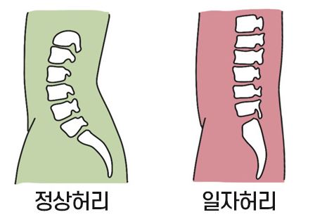 정상허리-일자허리