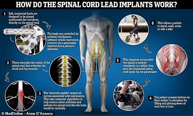 하반신 마비 환자를 위한 혁신적인 척수 임플란트 VIDEO: Surgeons insert spinal cord implant to activate paraplegic's 