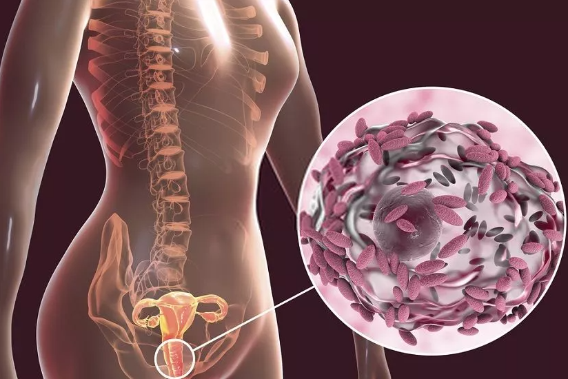  여성 질분비물 냄새의 원인 가드넬라바지날리스(Gardnerella vaginalis) 세균