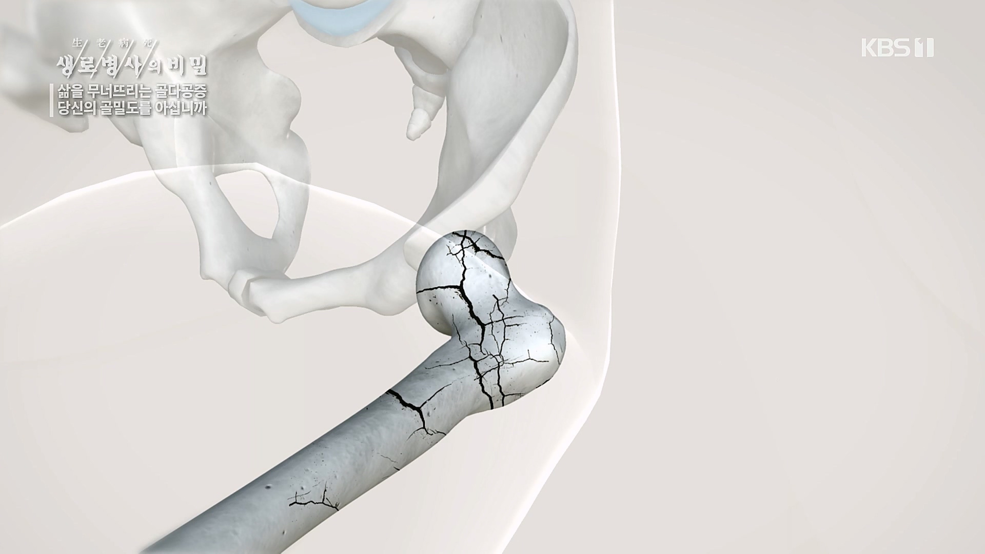 생로병사의 비밀.E852.230118p.H264-F1RST.mp4_20230120_200303.173.jpg