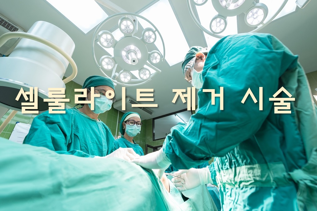  셀룰라이트 제거 시술과 셀룰라이트 없애는 방법