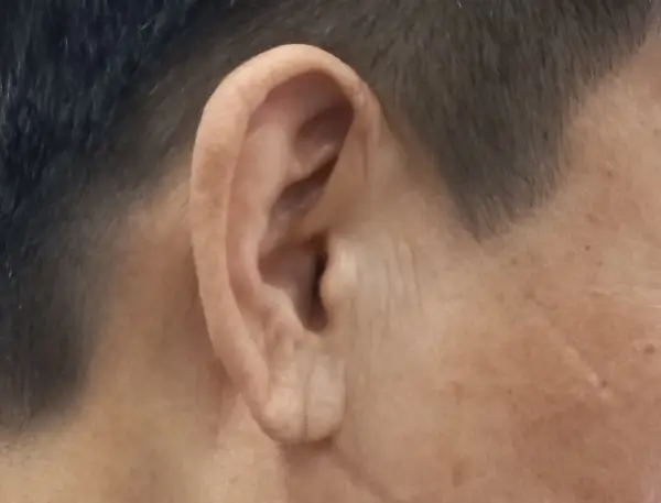 귓볼주름