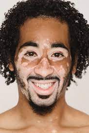 Vitiligo 정의 원인 증상 치료 예방 1
