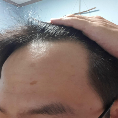  [실제 사용 후기] 폴텐 앰플 후기-탈모 관리템