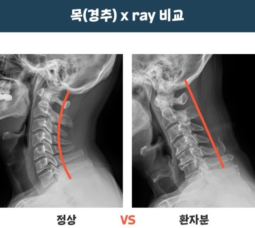 목디스크 비교이미지