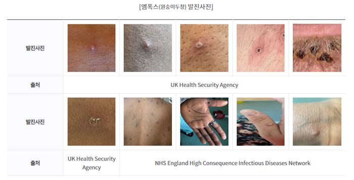 Mpox 증상