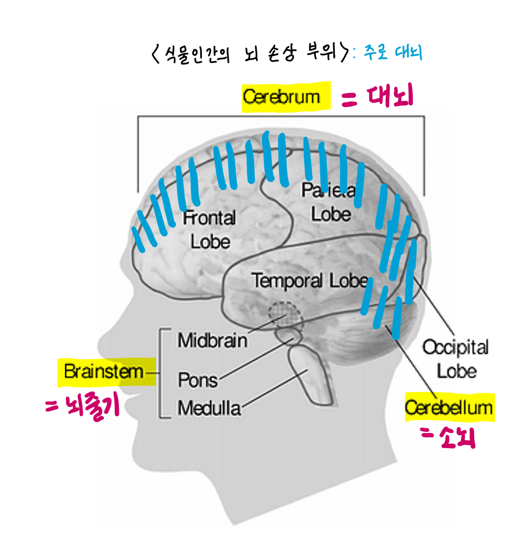  김정은 식물인간/식물인간과 뇌사의 차이점 ?/스탠트 시술?/식물인간은 다시 살아날 수 있을까?