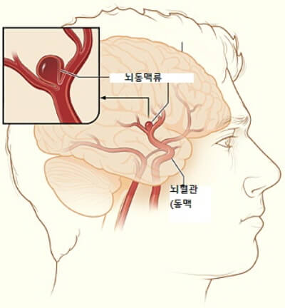 의학용어 ICH 뜻 Intracerebral hemorrhage 경막외출혈 경막밑출혈 거미막밑출혈 뇌내출혈 치료법