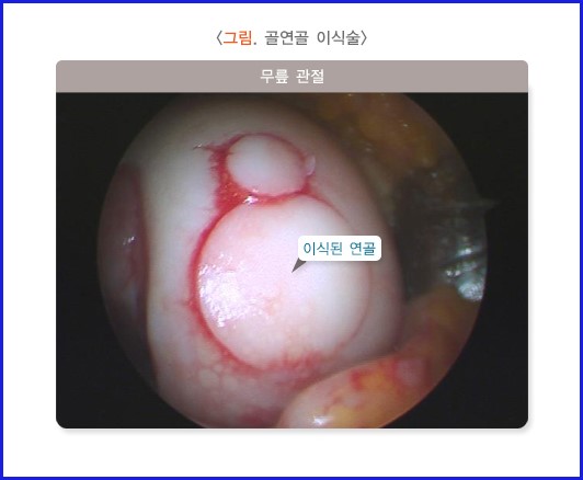 무릎 연골- 이식된 연골