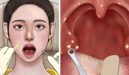  편도결석 예방법과 치료법 총정리