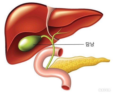 담낭 담석