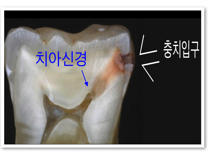 전주 완주 익산 치과 충치 치료 지르코니아