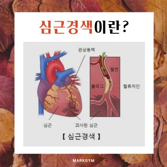 심근경색 초기증상