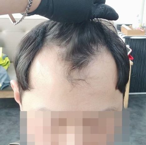  탈모 초기 증상과 종류 해야 하는 5가지 행동들 알아보자