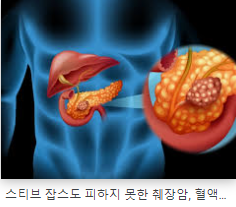  췌장암 초기증상 과 원인 및 진단방법 ( 자가진단 7가지  )