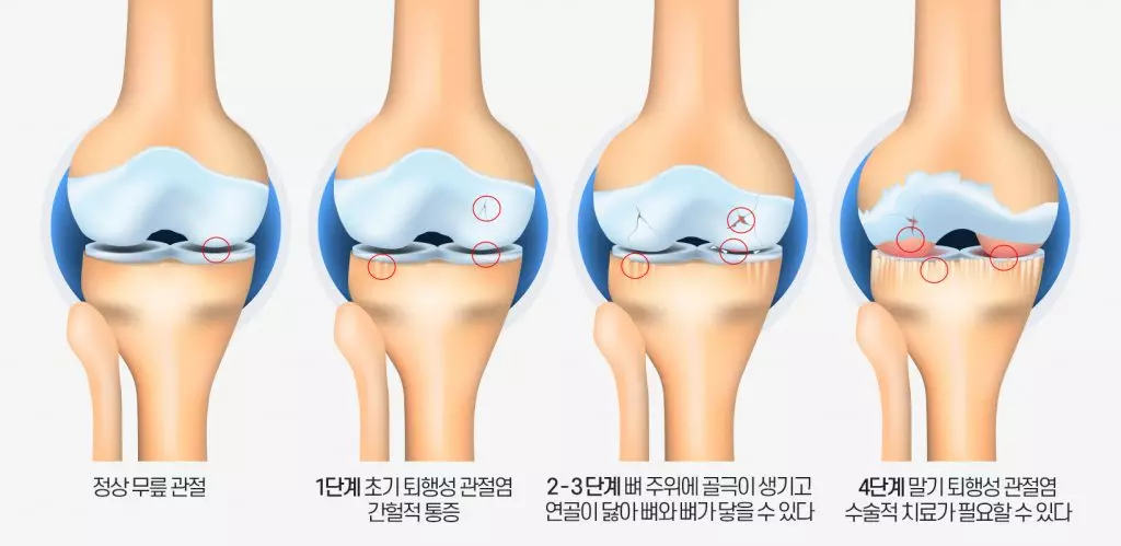 관절염(arthritis)