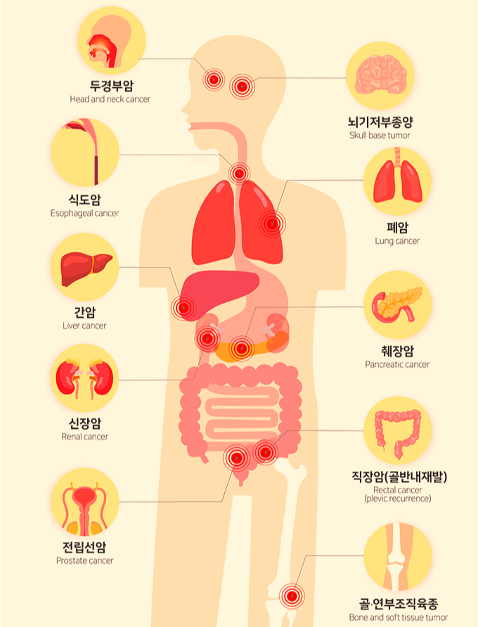 중입자치료 대상 암종