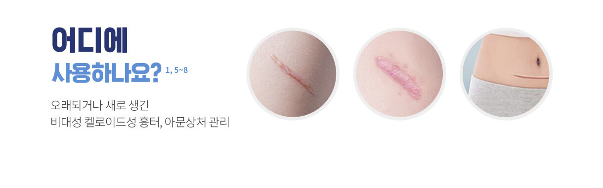 수술 켈로이드 흉터 연고