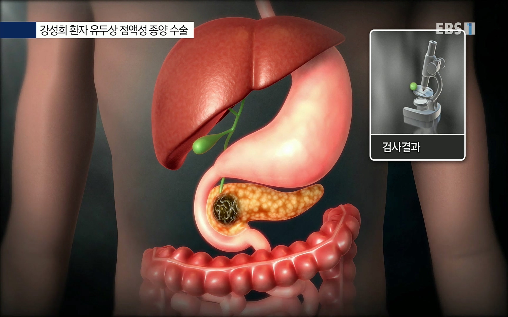 EBS 명의 헬스케어 - TV - 교육의 중심 EBS[명의 스페셜] 공포의 암, 췌장암, 담도암, 담낭암.mp4_20220902_210913.618.jpg