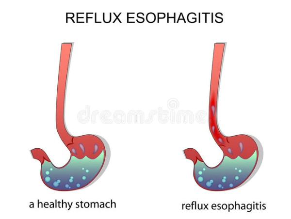 역류성 식도염이란