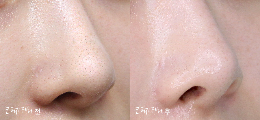 이거보다 더 쉬운게 있나 코 피지 제거 방법 2