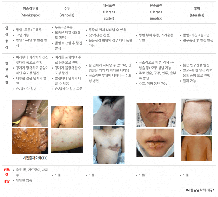 원숭이 두창 수두 대상포진 홍역증상 비교