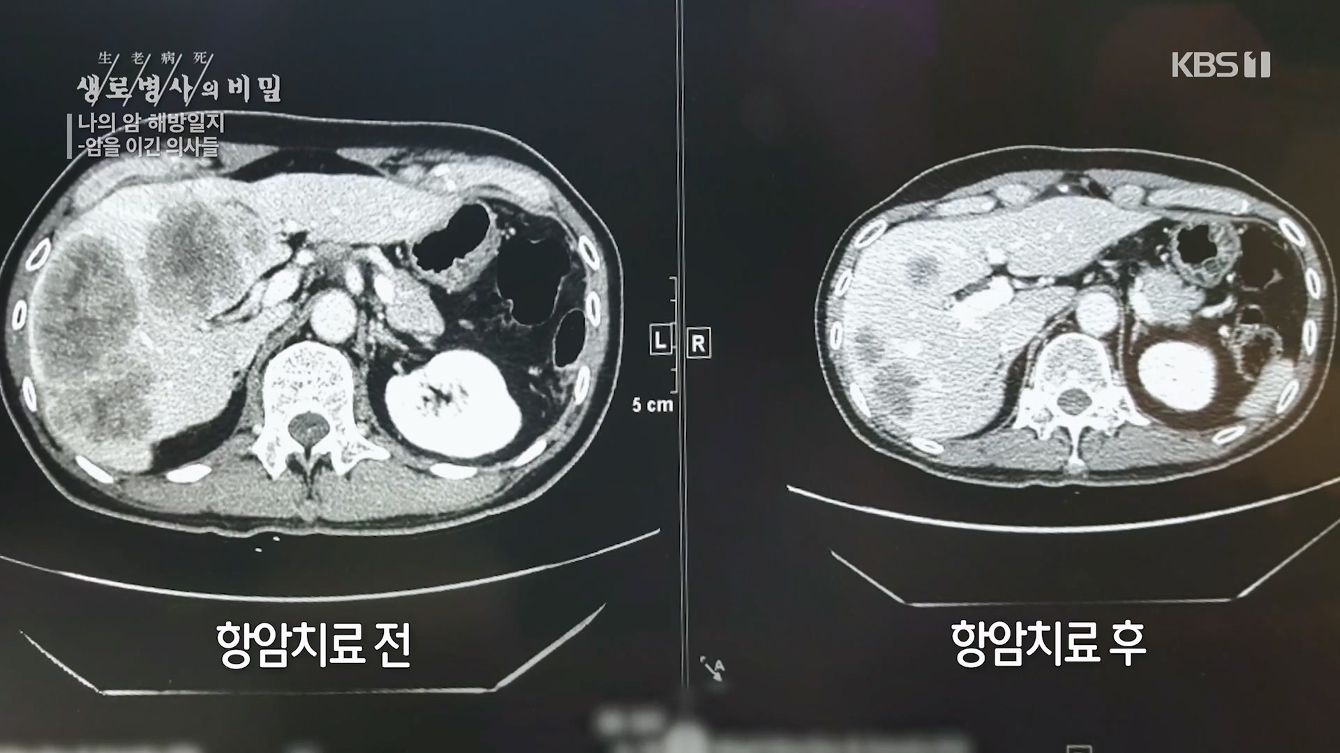 생로병사의 비밀.E889.231129p.H264-F1RST.mp4_20231130_201829.046.jpg