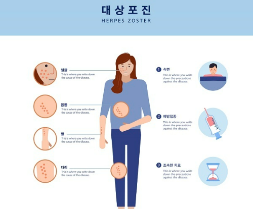  대상포진 원인 치료 예방에 대해 알아보자