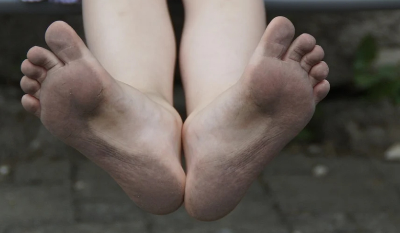  티눈 생기는 이유와 발바닥 티눈 제거 방법 / 자가 치료 가능?