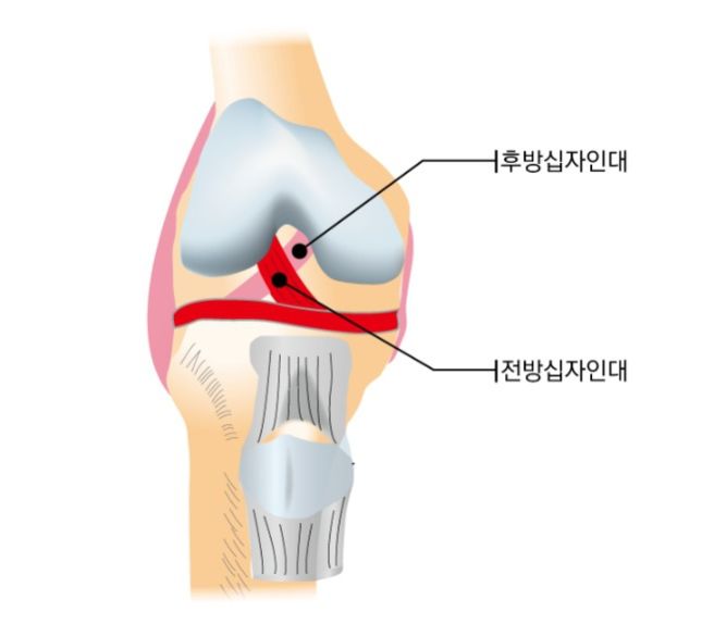 무릎 인대 파열 증상