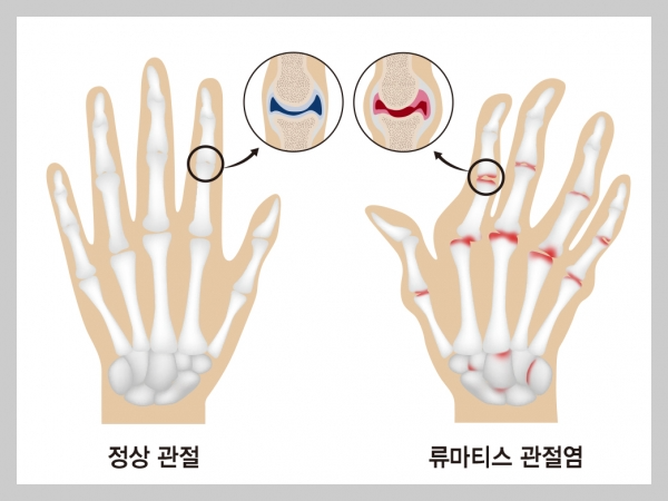 [건강정보] 류마티스 관절염 예방, 류마티스 관절염은 완치될 수 있을까?