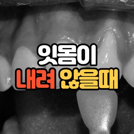 잇몸이 내려 앉을 때