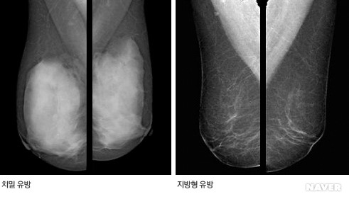  유방촬영술[Mammography]