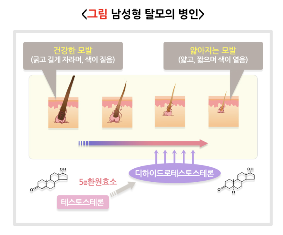 탈모의 병인