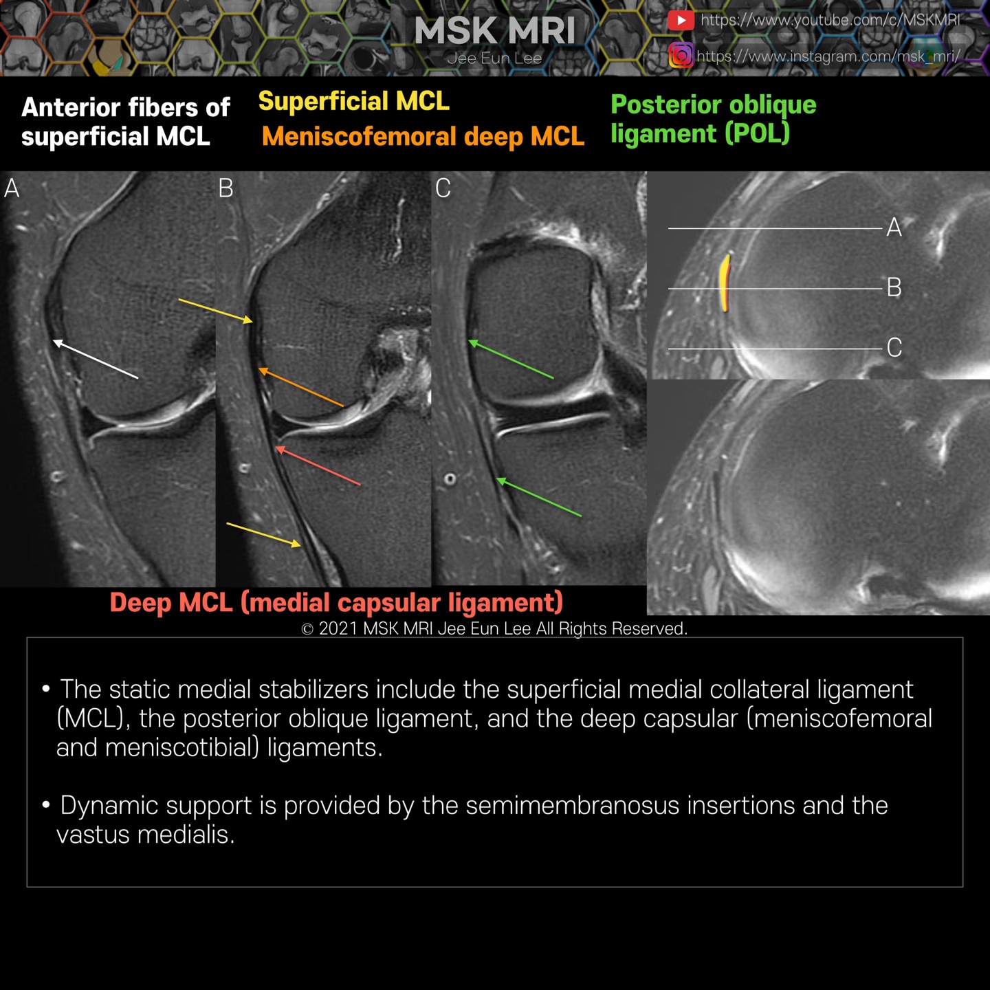 medial collateral ligament mri