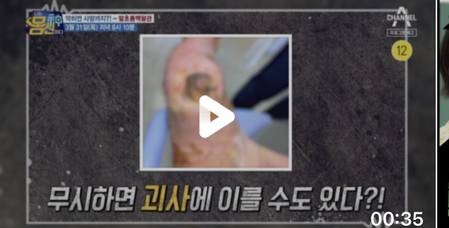  나는몸신이다 말초동맥혈관을뚫어라 혈관건강 377회 0331